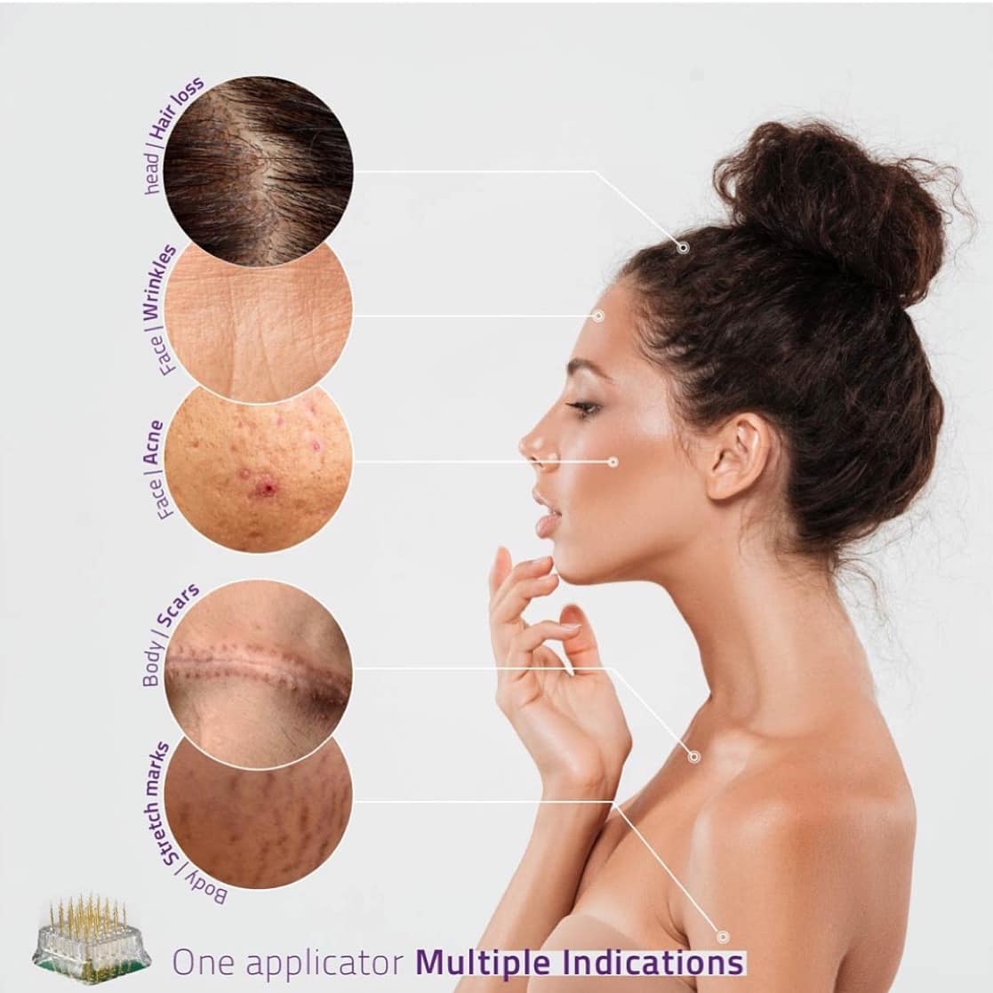 Chemical peels Overland Park Kansas